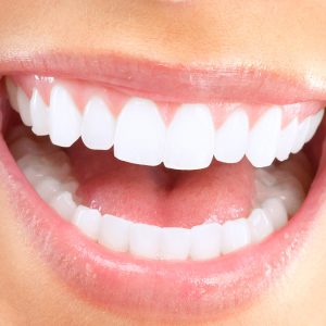 Teeth whitening in Cartagena – close-up of a bright smile